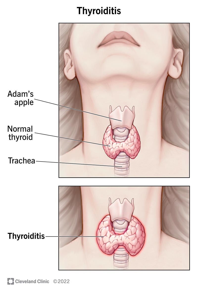 Tiroiditis: Understanding Thyroid Inflammation and Its Diverse Symptoms